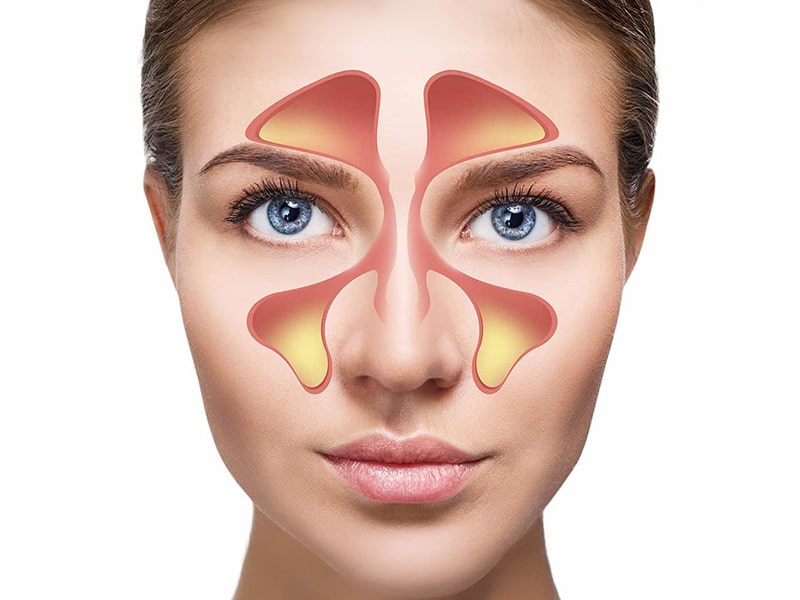 Cirugía Senos Paranasales