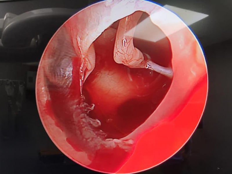Timpanoplastia Cirugía de Timpano2-min