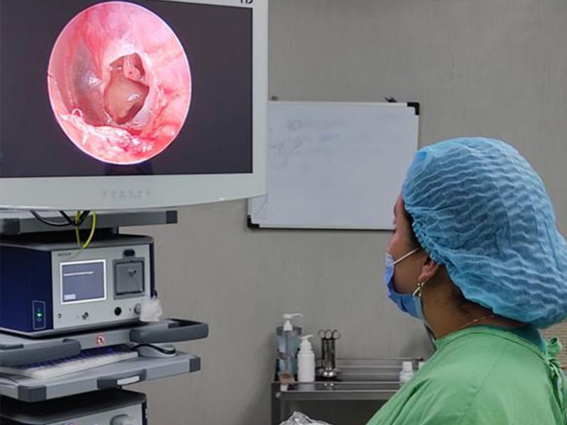 Timpanoplastia Cirugía de Timpano4-min